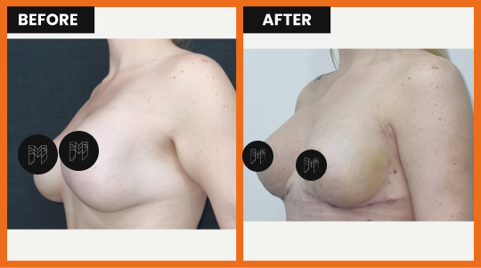 Woman with breast augmentation